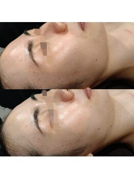 ボーソリューション(Beau-Solution)/【20代　サマー水光ピーリング】