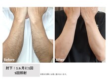 ビープランニング(B-PLANNING.)/【メンズ脱毛も、大人気】