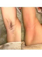 シンボディメイク 恵比寿(SiN BODY MAKE)/脇ワックス Before→After