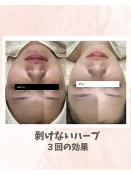 リンフェイス 浦安店(RINFACE)/ハーブピーリングでデトックス