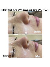 メリナ(Melina)/毛穴洗浄&マツヤニ&エクソソーム