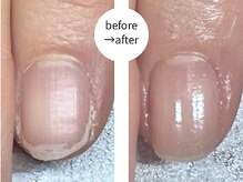 エマ(EMA)/二枚爪と平たい爪にお悩みの方