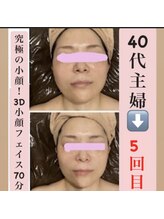 マール(Mar)/ビフォーアフター！小顔/たるみ