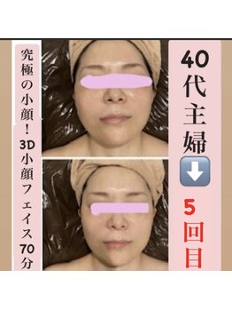 マール(Mar)/ビフォーアフター!小顔/たるみ