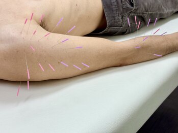 とだ鍼灸院/四O肩、五O肩、野球肩