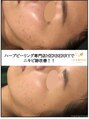 ハーバリー ハーブピーリング 岐阜(HERBERRYハーブピーリング)&nbsp;【剥離あり】リベルハーブピーリングならニキビ跡にも効果発揮◎