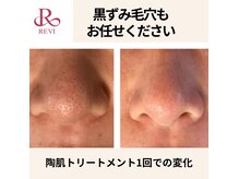 ミソ(miso)の雰囲気(毛穴の黒ずみ諦めてませんか?)