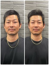 長寿鍼灸院 長寿整骨院/men's美容鍼50本効果★