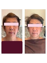 アクア エステティコ 亀有(ACQUA estetico)/小顔エイジングケア　3回