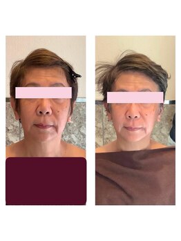 アクア エステティコ 亀有(ACQUA estetico)/小顔エイジングケア　3回