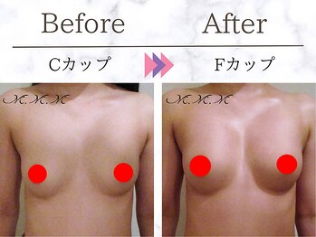 エムエムエム 表参道Luxeサロン(M.M.M)/【バストアップ例】　C→Fカップ