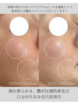 リニューサロン 本院(renew salon)/バクテリウムピール