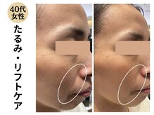 ディレイア ザ コスメ 有楽町マルイ店(direia the cosme)/たるみ/リフト/しわ［有楽町］