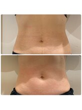 ルナート(Lunart)/美腸くびれモニター