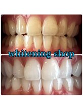 ホワイトニングショップ 阪急伊丹店/お客様のビフォーアフター