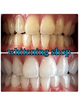 ホワイトニングショップ 阪急伊丹店/お客様のビフォーアフター