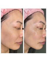 悠羽(yuuwa)/ヒト幹細胞導入写真