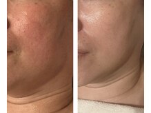 アドビューティ(Add Beauty)/≪プラズマフェイシャル≫