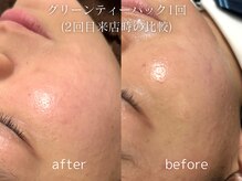 グランクウォーレ(Gran Cuore)/肌荒れケア★