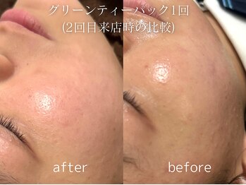 グランクウォーレ(Gran Cuore)/肌荒れケア★