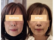 バリューネクスト 青葉台/◆レモンボトル脂肪分解◆小顔