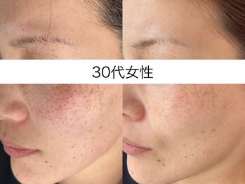 シミケア専門店 SAKURA 平塚店/平塚シミケア/伊勢店シミケア