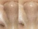 エマクラン(emmaclan)の写真/【春の毛穴大掃除】優しくしっかり洗浄！花粉も汚れもリセットして、つるんとした鼻先や頬に◎