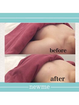 ニュウミー 諏訪本店(newme)/最新機器NRでふっくら美バスト