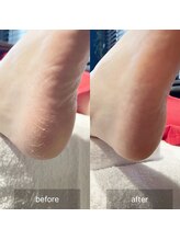 アイル(isle)/【かかとガサガサお悩み】お客様