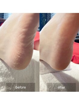 アイル(isle)/【かかとガサガサお悩み】お客様