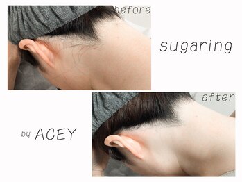 エイシー(ACEY)/ビフォーアフター☆うなじ