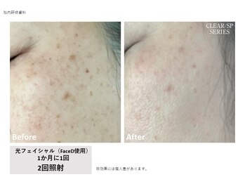 ラキュア(La Cure)/シミ美白ケアもお任せ下さいませ