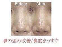 ラプリ 新宿店(Raplit)/隆鼻＋輪郭矯正40分10回