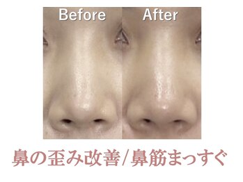 ラプリ 新宿店(Raplit)/隆鼻+輪郭矯正40分10回