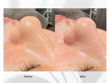 アン ビューティー(ann beauty)/施術1回【症例写真】30代