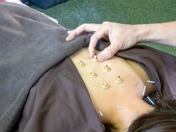 鍼灸接骨院 トレスの写真/ほぐしきれない深層のコリは鍼灸で解消！痛みをおさえた細鍼が深部に届き、頑固な疲れを根本から整えます。