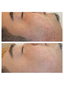 メンズラボ(Men's Lab)/ハーブでお肌綺麗にしませんか?