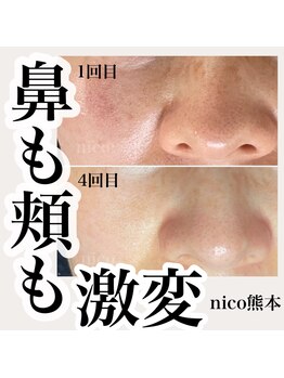 ニコサロン(nico salon)/毛穴エクストラクションプロ