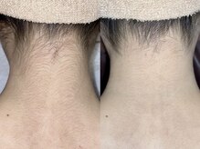ビジュー(bjyou)/うなじ脱毛