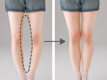 バランス鍼灸整骨院/O脚矯正