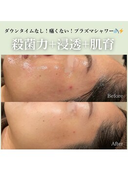 ハーブのほし/DTなし!プラズマシャワー