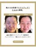 エステ版ヒアルロン酸！シワやたるみに！リフトアップエステ24200円→5980円