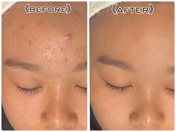 オプス ライフビューティー(OPS×LIFE BEAUTY)/ニキビケアなら…