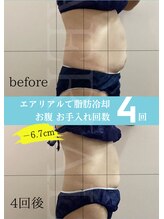 エアリアル 中津店/脂肪冷却　ワンサイズダウン♪