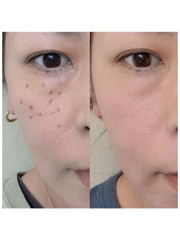 シェアキ(Chez Aki)/シミケアBefore/After