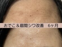 ベアール(beal)/効果No.1たるみシワケア6ヶ月