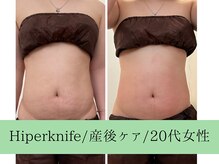 ソルニス(Solnis.)/痩身☆脂肪分解/ハイパーナイフ