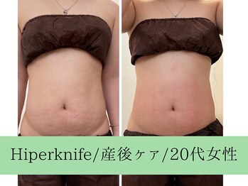 ソルニス(Solnis.)/痩身☆脂肪分解/ハイパーナイフ