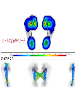 メディカルジャパン 吉祥寺/女性の歩行分析