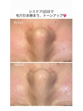 ココ(COCO)/シミケア、ビフォー、アフター